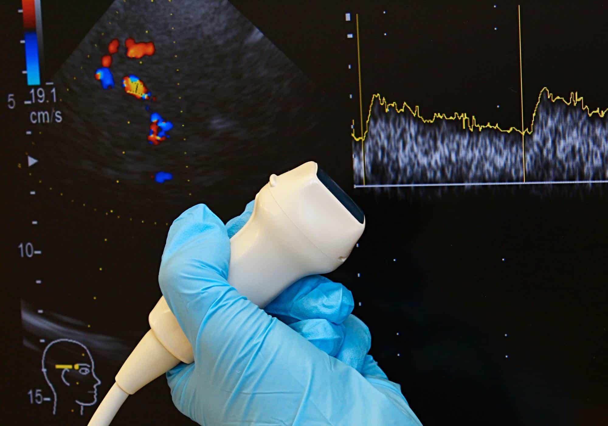 TMS Therapy Atlanta, GA